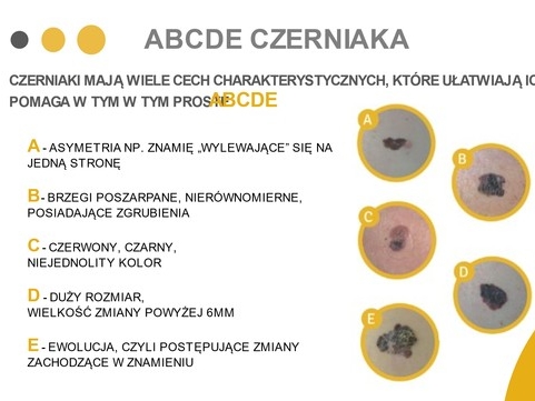 zdjęcia poglądowe czerniaka i jego cech charakterystycznych